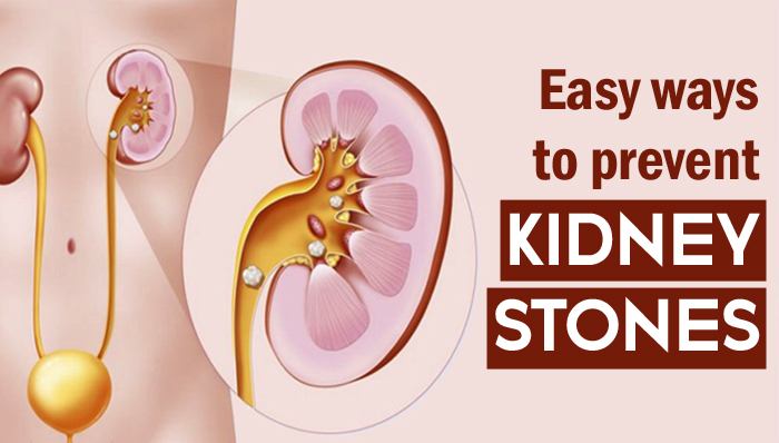 Decreased risk of kidney stones